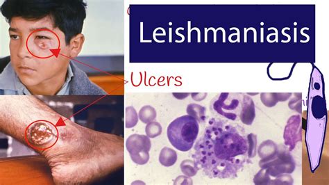 Signs And Symptoms Of Leishmaniasis | SexiezPicz Web Porn