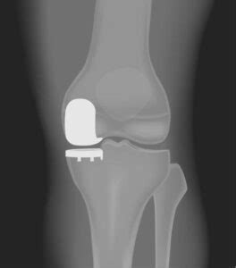 Partial Knee Replacement | Unicompartmental Arthroplasty | Partial Knee ...