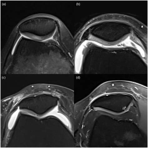 Chondromalacia patella was classified using a modified Noyes ...