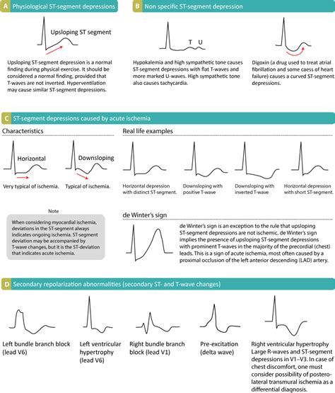 ECG interpretation: Characteristics of the normal ECG (P-wave, QRS ...