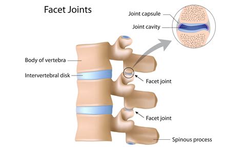 Facet joint syndrome - London Neurosurgery - Spine