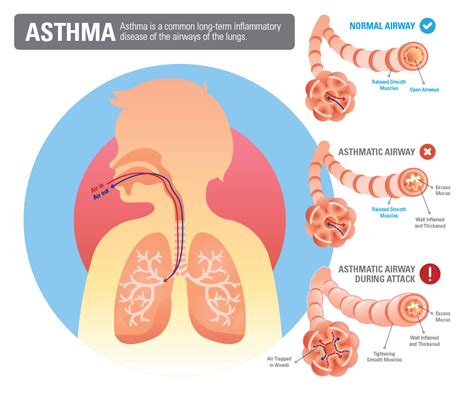 Asthma & COPD - Legacy for Airway Health