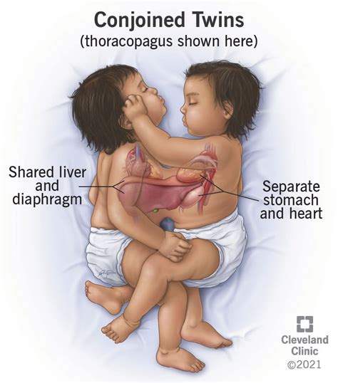 Conjoined Twins: Definition, Causes & Outlook