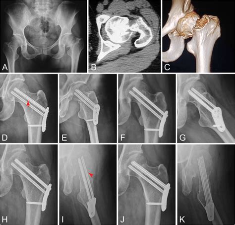 Measurement of CCD angle (a), amount of femoral neck shortening (b ...