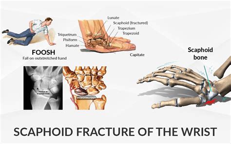 Scaphoid Fracture of the Wrist - Dr. Saurabh Aggarwal