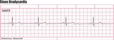 Ecg And Drugs - HooDoo Wallpaper