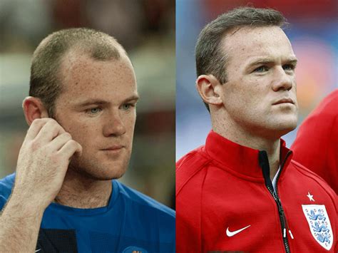 8 Football Players Who Had Hair Transplantation - Cosmeticium