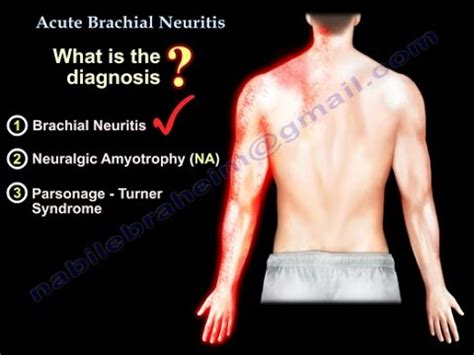 Brachialneuritis - Gesundheit - 2024