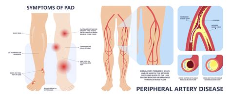 Peripheral Artery Disease — Vascular Cures