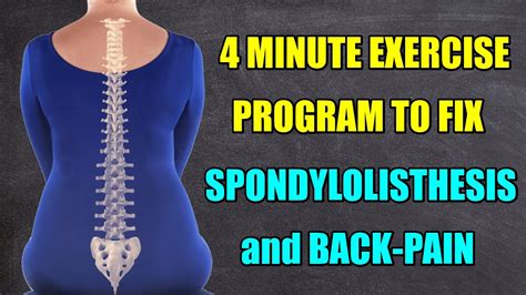 A 4 MINUTE EXERCISE PROGRAM TO FIX SPONDYLOLISTHESIS and BACK PAIN ...