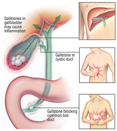 Gallbladder Pain & Problems - Causes, Symptoms, Diganosis, Treatment