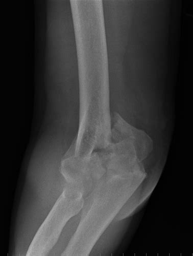 Current treatment strategies for bicolumnar distal humerus fractures ...