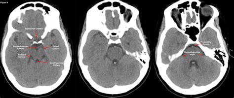 The ED Guide to Neuroimaging: Part 1 — NUEM Blog