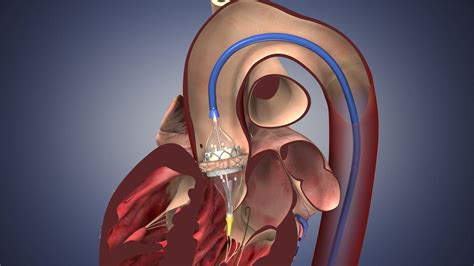 Edwards Valve Outperforms Medtronic’s in First Comparison - Bloomberg