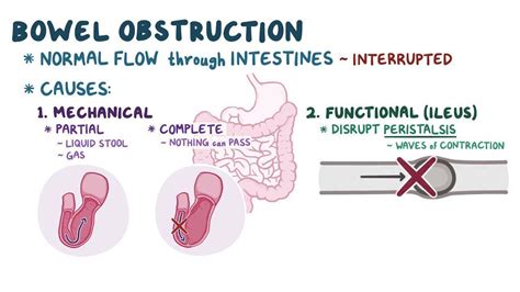 Bowel obstruction: Video, Causes, & Meaning | Osmosis