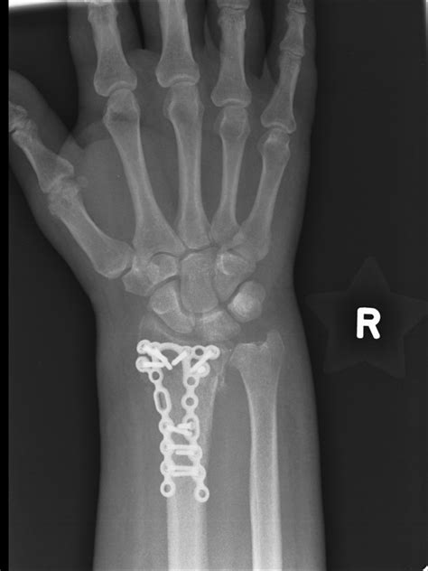 Wrist Fracture Treatment - Manchester Hand & Wrist Surgery