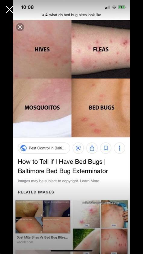 Bed Bug Bites Pictures On Hand