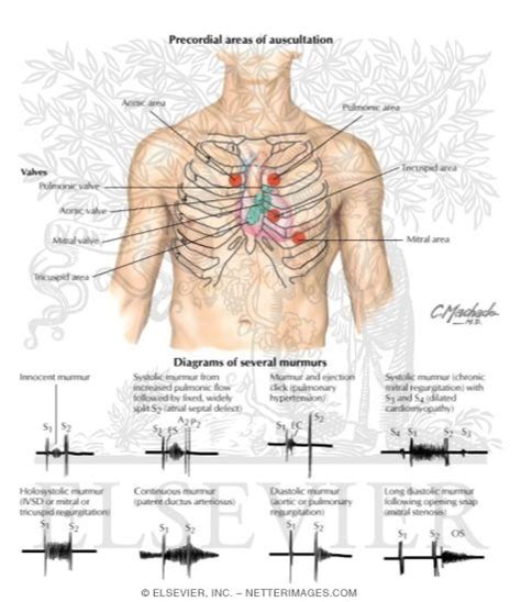 Cardiac Auscultation: Precordial Areas of Auscultation