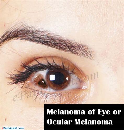 What is Melanoma of Eye or Ocular Melanoma | Causes | Symptoms ...