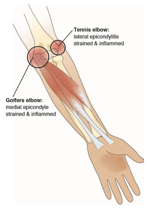 Hand, Wrist, Forearm, and Elbow muscle imbalances - Strong Links Fitness