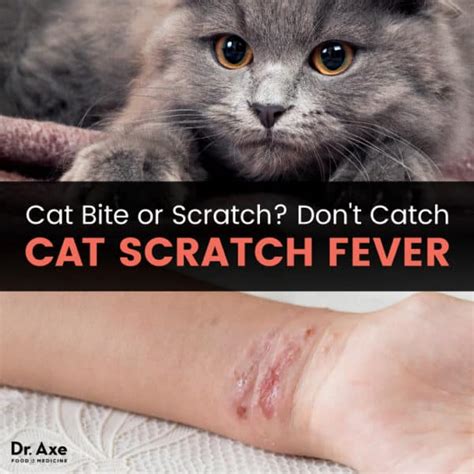 Cat Scratch Fever: See Your Doctor + Find Natural Relief - Dr. Axe