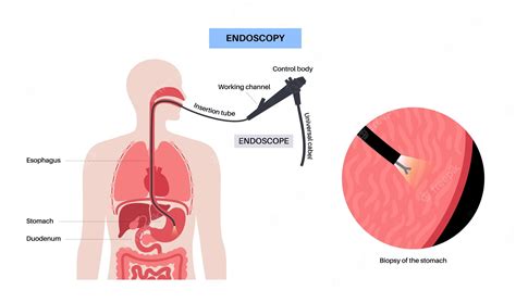 Premium Vector | Gastroscopy procedure gastroenterologist uses a ...