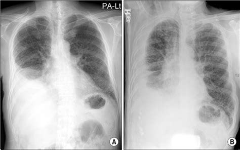 Chest X-ray. Chest poteroanterior (A) and right decubitus view (B) show ...