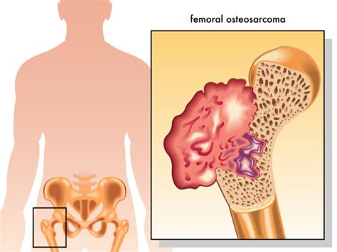 Osteosarcoma Symptoms May Point to a Rare Type of Cancer - University ...