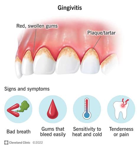 Bleeding Gums: Causes, Prevention and Treatment - Dental Lifeline