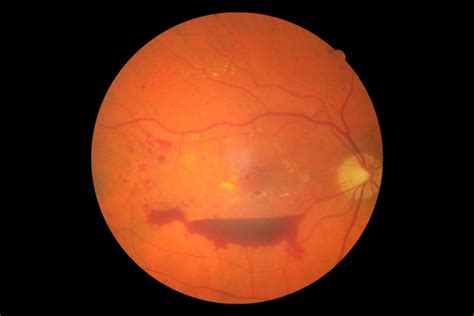 diabetic retinopathy 3 - Eyes Wide Bay