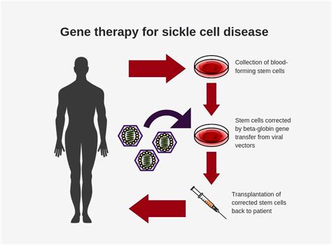 sickle cell disease cure Sickle cell disease - Diseases Club Center 2