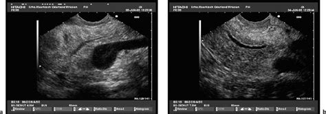 Endoscopic Ultrasound in Chronic Pancreatitis | Radiology Key