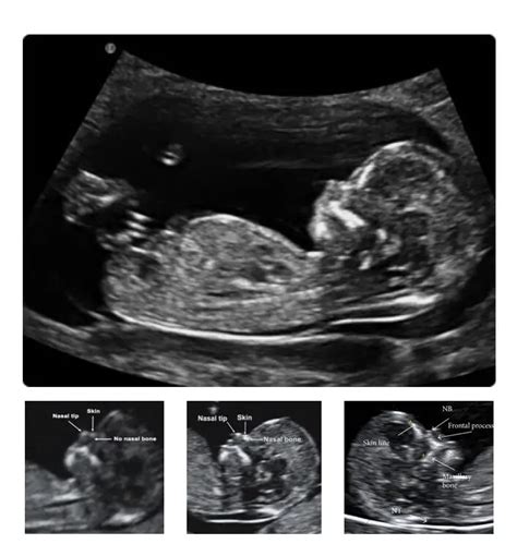 Trisomy 21 (Down Syndrome): Definition, Causes, Symptoms, Pictures and ...