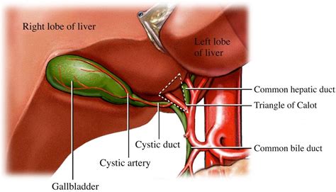 Medical Legal Demonstrative Evidence: Bile Duct Injury Complications of ...