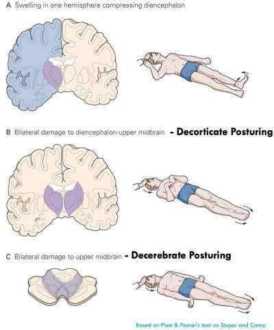 What Does Triple Flexion Mean: Unlocking The Key Movements