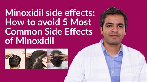 Minoxidil side effects: How to avoid Minoxidil side effects | 5 Common ...