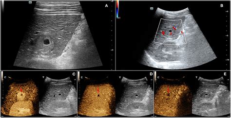 Frontiers | Contrast-Enhanced Ultrasound Findings of Hepatocellular ...