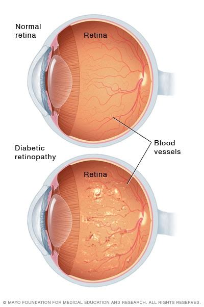 Diabetic retinopathy - Symptoms and causes - Mayo Clinic