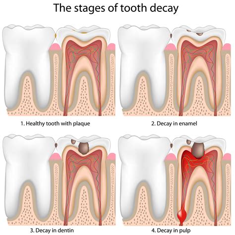 Stages of Tooth Decay - Troy, MI - Restorative Dentistry