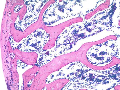 Trabecular Bone