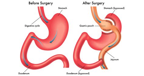 Dallas Gastric Sleeve surgery Pre-Diet and 4 weeks diet/ ESG Endoscopy ...