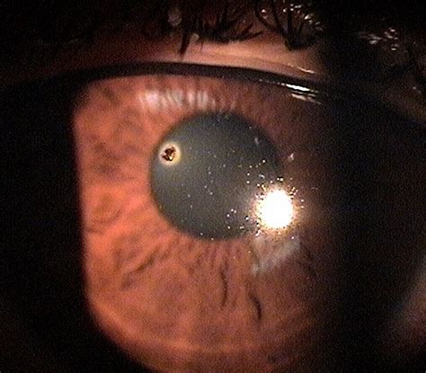 T15.01XA-02XA Corneal Foreign Body - Decision-Maker PLUS