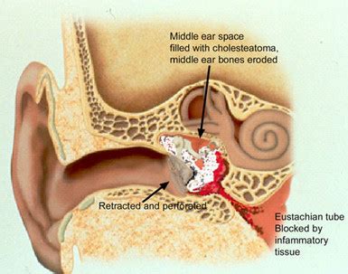 Cholesteatoma | Current Health Advice, Health Blog Articles and Tips