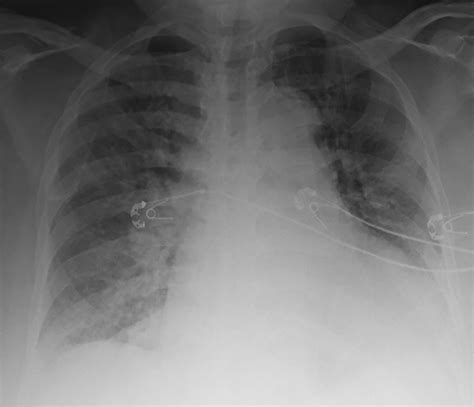 Day 2 - Congestive Heart Failure — The Intern at Work