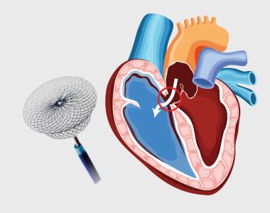 Atrial Septal Defects Symptoms, and Treatment | Dr. C Raghu