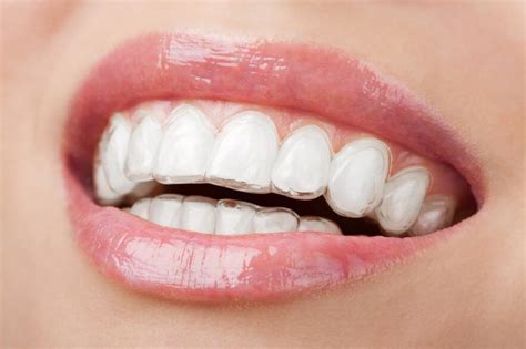 What Is Invisalign, and How Does It Work? | Stachel Orthodontics