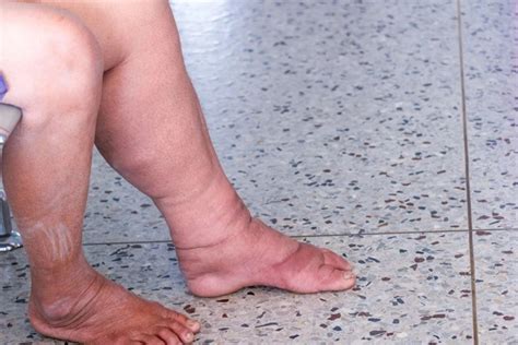 Elephantiasis: Causes, Symptoms, Diagnosis, and Treatment – Sujata ...