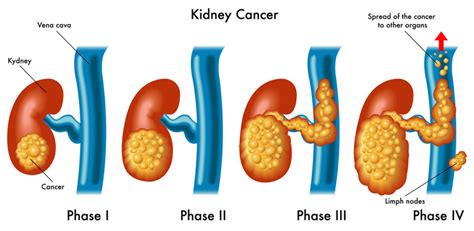 Kidney Cancer Symptoms Usually Occur Later Rather Than Sooner ...