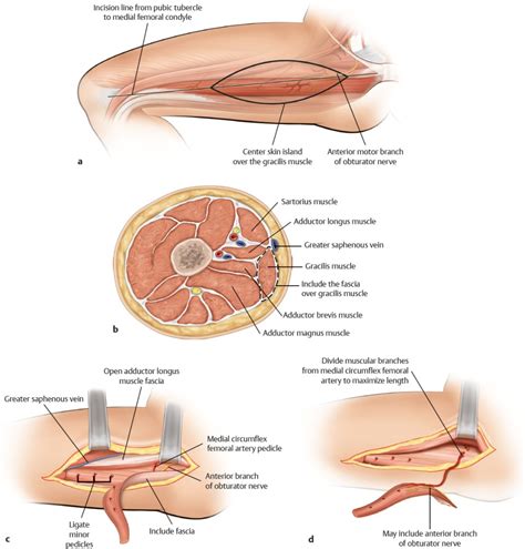 Gracilis Muscle/Musculocutaneous Flap, Innervated Flap | Plastic ...