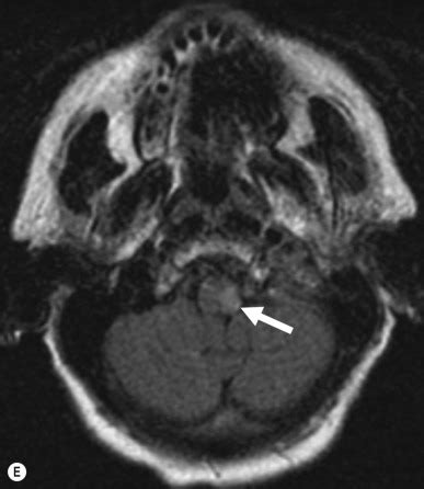 Eye Movement Disorders: Conjugate Gaze Abnormalities | Ento Key